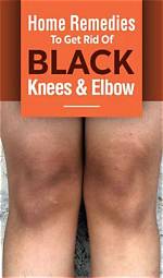 10 Natural Tricks to Remove Dark Knees and Elbows