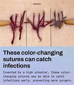 17-Year-Old Makes Color Changing Sutures That Detect Infection