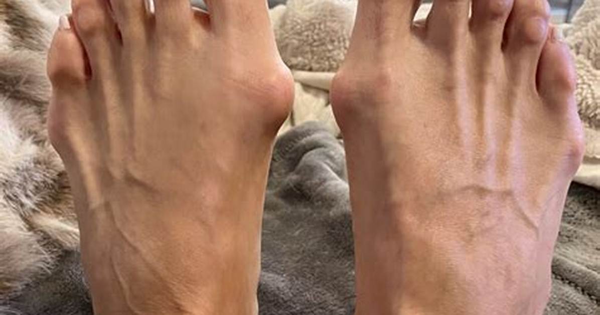 3D Bunion Correction | Weil Foot & Ankle Institute