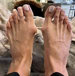 3D Bunion Correction | Weil Foot & Ankle Institute