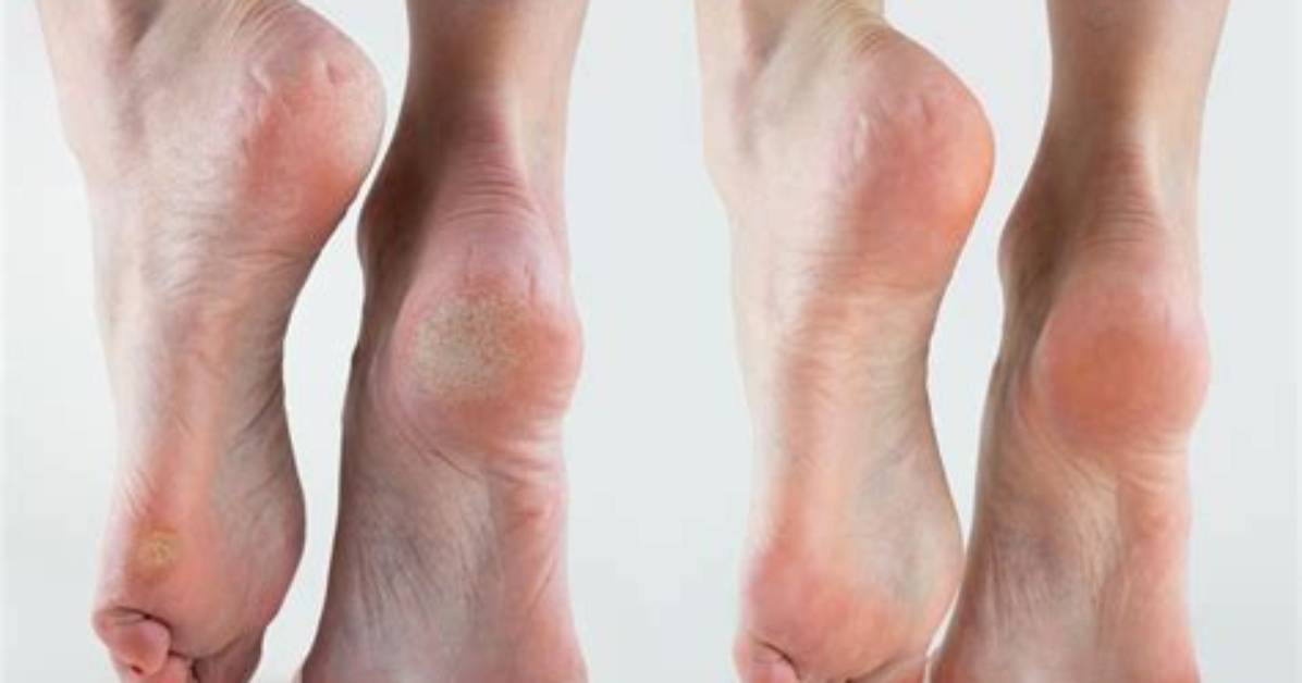 Arch Disorders