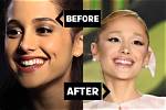 Ariana Grande’s Facial Transformation Sparks Plastic Surgery Speculation: Uncovering the Truth