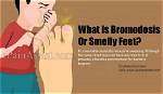 Bromodosis – Causes and Management of Smelly Feet