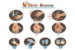Burn Treatment