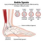 But It's Just an Ankle Sprain!