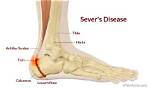 Calcaneal Apophysitis - Sever’s Disease