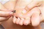 Calluses and Corns | Foot and Ankle Specialists