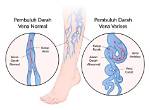 Cara Menghilangkan Varises Di Kaki, Langsung Sembuh Dan Kaki Kembali Mulus