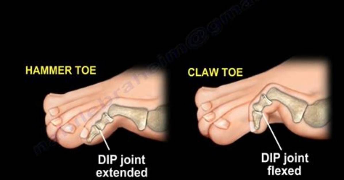 Claw Toe | Hammer Toe