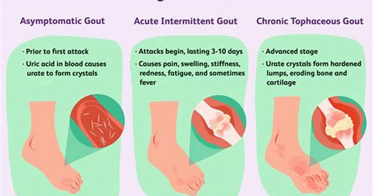 Common Gout Symptoms and How to Prevent Them