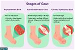Common Gout Symptoms and How to Prevent Them