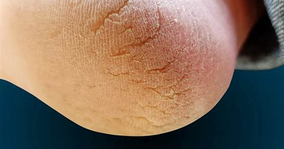 Cracks and Fissures | Foot and Ankle Specialists