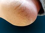 Cracks and Fissures | Foot and Ankle Specialists