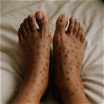 Dark Spots on the Top of Feet and Ankles