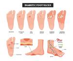 Diabetic Foot Care - Symptoms and Treatments