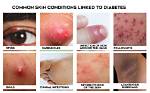 Diabetic Itching: Causes, Symptoms & Tips to Cope