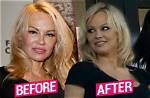 Did Pamela Anderson Have Plastic Surgery? How She Looks Now