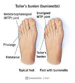 Do I Have a Bunionette on My Pinky Toe?