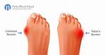 Do I Have a Tailor’s Bunion? and If So, What Can I Do About It?