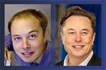 Elon Musk Before Hair Transplant | the Enigmatic Evolution