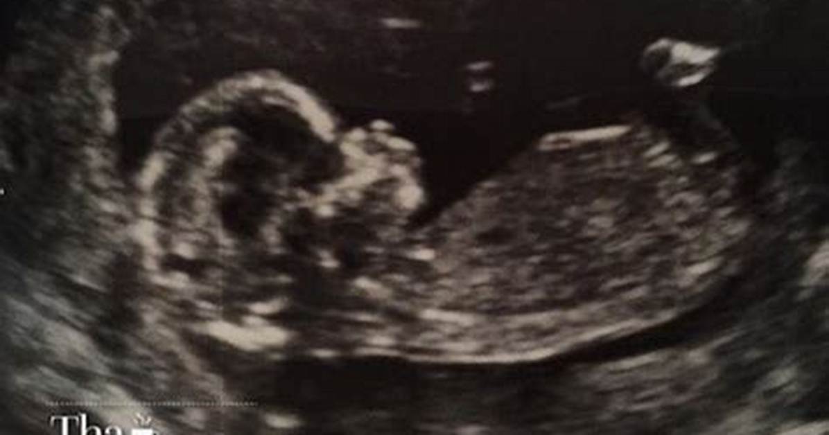 Faking Pregnancy? Deleted Ultrasound Photo Raises Questions