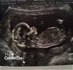 Faking Pregnancy? Deleted Ultrasound Photo Raises Questions