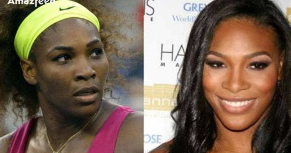 Fascinating Story About Serena Williams Facial Surgery