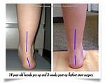 Flat Foot Treatment, Pain Relief
