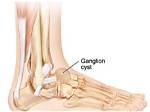 Ganglion Cyst | Artisan Foot and Ankle Specialists