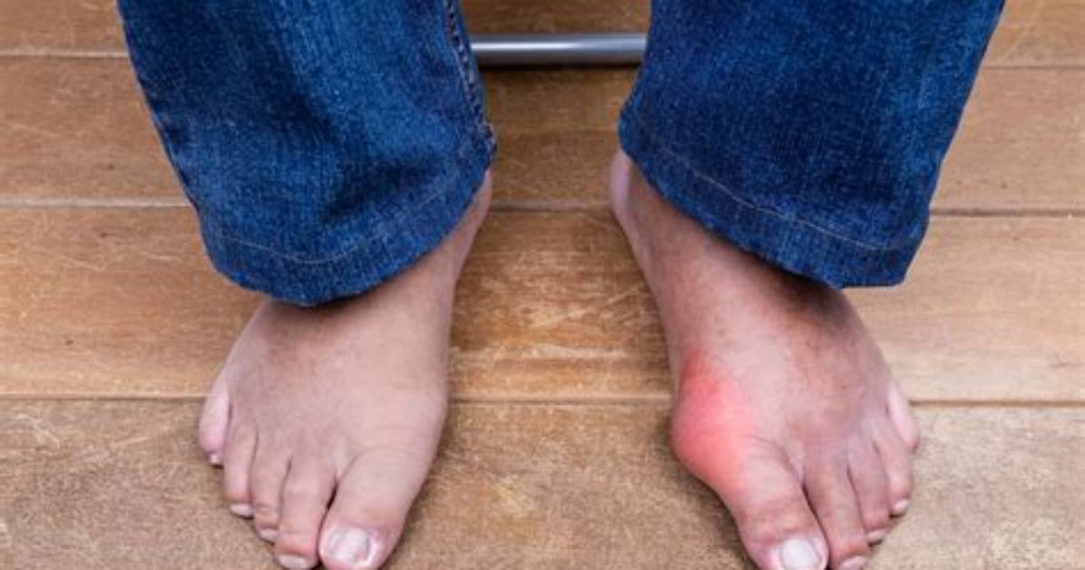 Gout Specialists - Sacramento Foot and Ankle Center