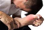 Gout Treatment in Santa Cruz and Watsonville, Ca | Santa Cruz Podiatrist