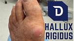 Hallux Rigidus | Foot and Ankle Specialists