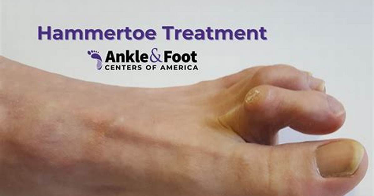 Hammer Toe Treatment in Santa Cruz and Watsonville, Ca | Santa Cruz Podiatrist