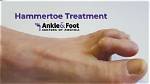 Hammer Toe Treatment in Santa Cruz and Watsonville, Ca | Santa Cruz Podiatrist