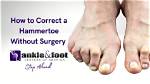 Hammertoe Pain, Relief, Treatment | Suffolk, Hampton, Virginia Beach Va