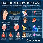Hashimoto's Disease and Ozempic: Understanding the Connection and Treatment Options