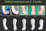 Healing Clubfoot, One Patient at a Time