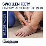 Here’s Why Your Feet Swell in Summer and What to Do About It!