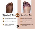 How Long Will My Broken Foot Be Casted? a Guide to Recovery and Treatment