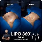 How Much Is Lipo 360 in Houston