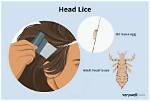 How to Tell If You Have Lice in Dreadlocks