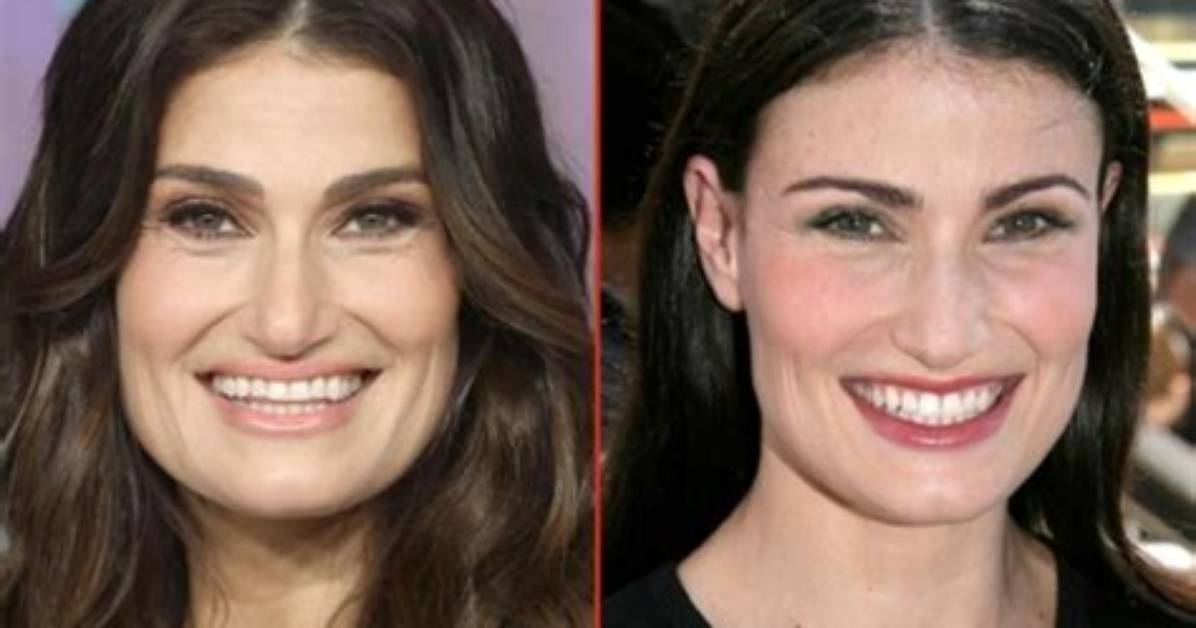 Idina Menzel Nose Job: Before and After Photos