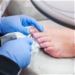 Ingrown Toenail | Foot and Ankle Specialists