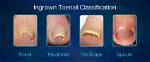 Is an Ingrown Toenail Serious?