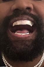 Kanye West Teeth Replaced with Expensive Titanium Dentures