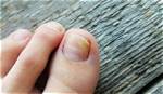 Laser Toenail Fungus Removal - Podiatrist in San Diego