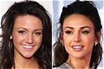 Michelle Keegan Chirurgie