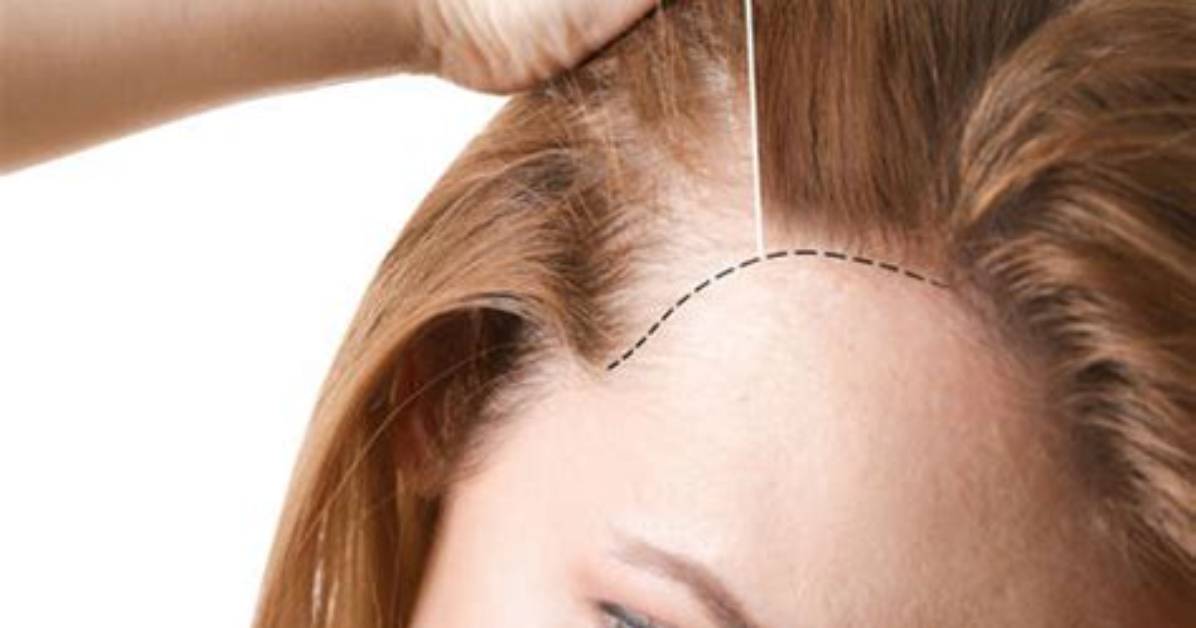 Microneedling Capilar, ¿El Nuevo Remedio Contra La Alopecia Es Un Rodillo Con Agujas?