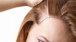 Microneedling Capilar, ¿El Nuevo Remedio Contra La Alopecia Es Un Rodillo Con Agujas?