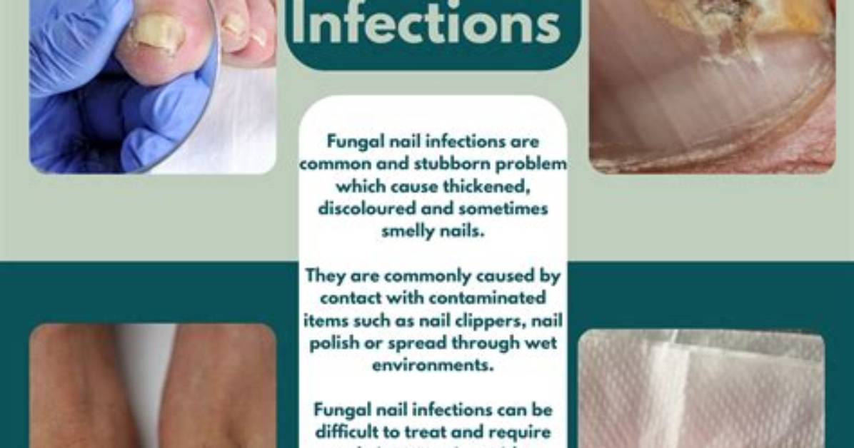 Nail Fungus - Symptoms, Causes and Treatments